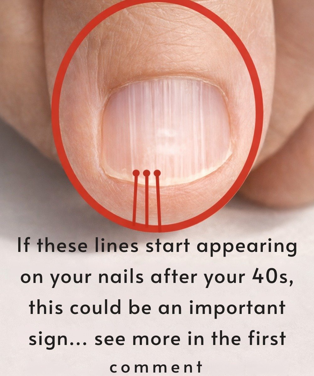 Vertical Ridges on Nails After 40: Why They Appear and When to Worry