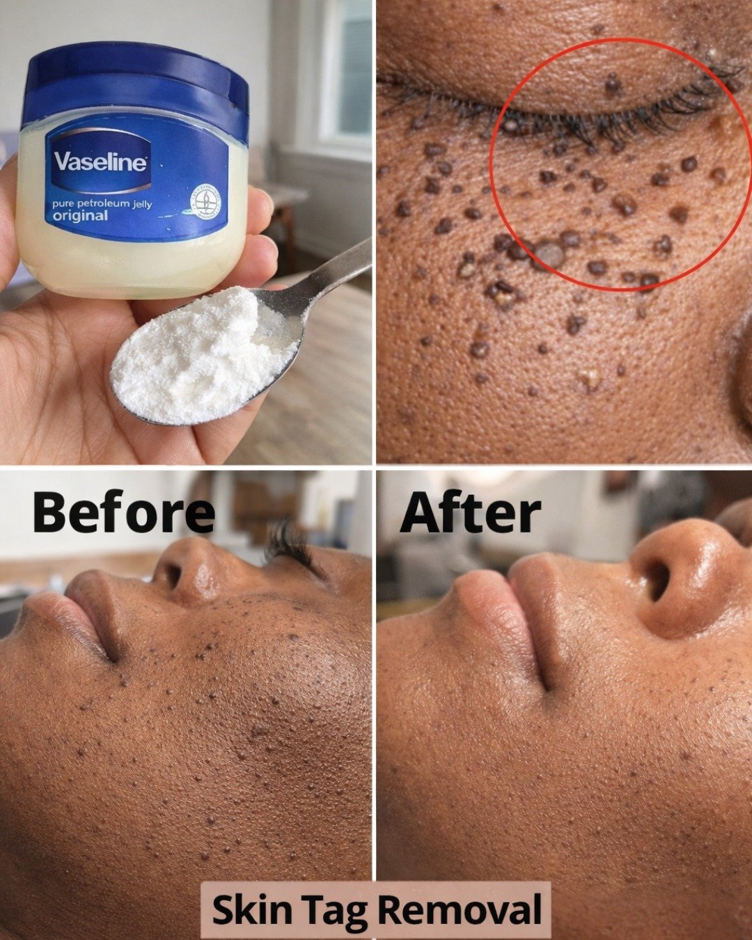 Those Stubborn Little White Bumps: Understanding Milia and Safe Ways to Improve Your Skin’s Appearance