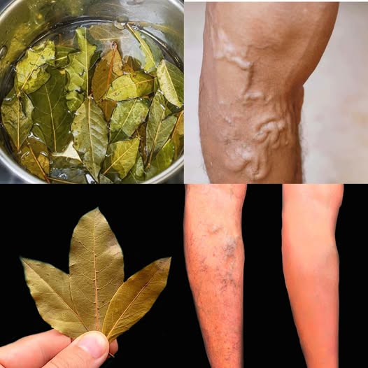 The Bay Leaf Oil Secret: Shrink Varicose Veins and Soothe Tired Legs