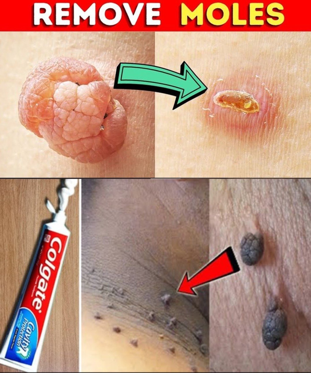 🧴 How to Remove Warts and Skin Tags Naturally (No Harsh Chemicals Needed)