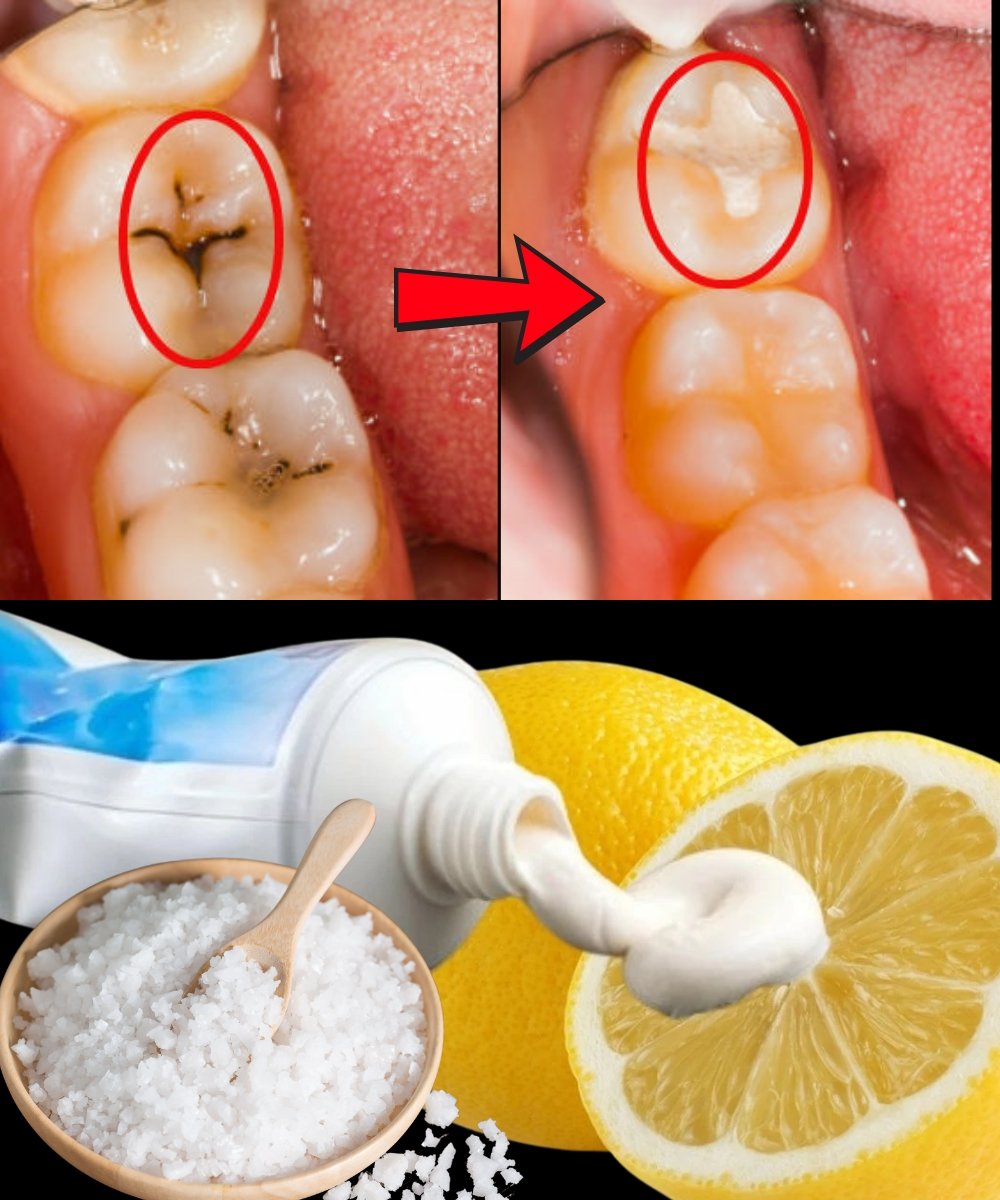 🦷 Heal Early Cavities Naturally: 6 Powerful Tips to Protect Your Smile