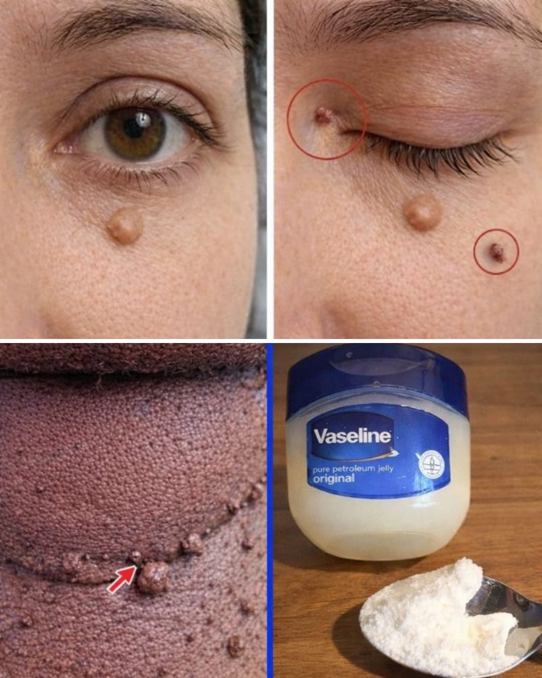 Those Stubborn Little White Bumps: Understanding Milia and Safe Ways to Improve Your Skin’s Appearance