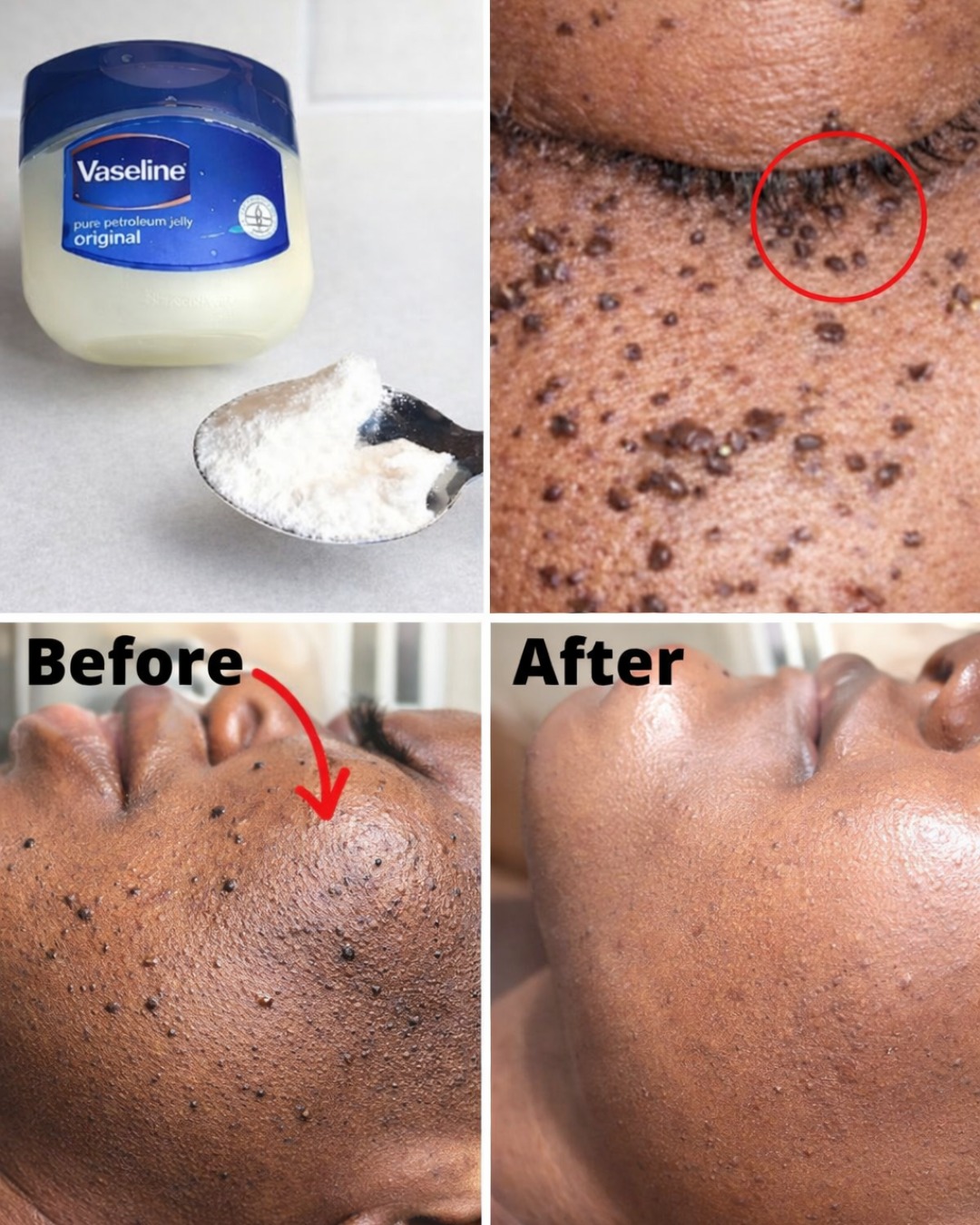 Those Stubborn Little White Bumps: Understanding Milia and Safe Ways to Improve Your Skin’s Appearance