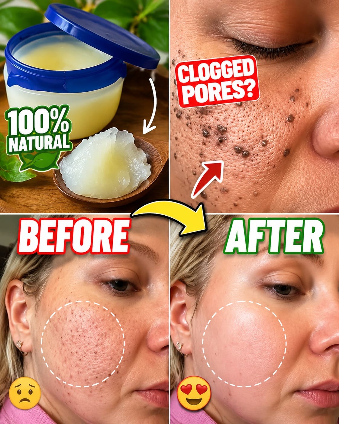 This Simple Vaseline Trick Is Helping Remove Skin Tags Overnight