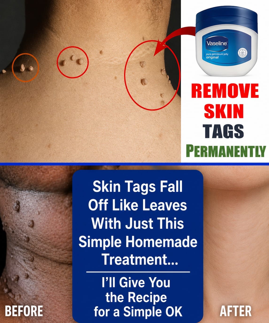 How to Remove Warts Naturally: Effective Home Remedies and Skin Care Tips