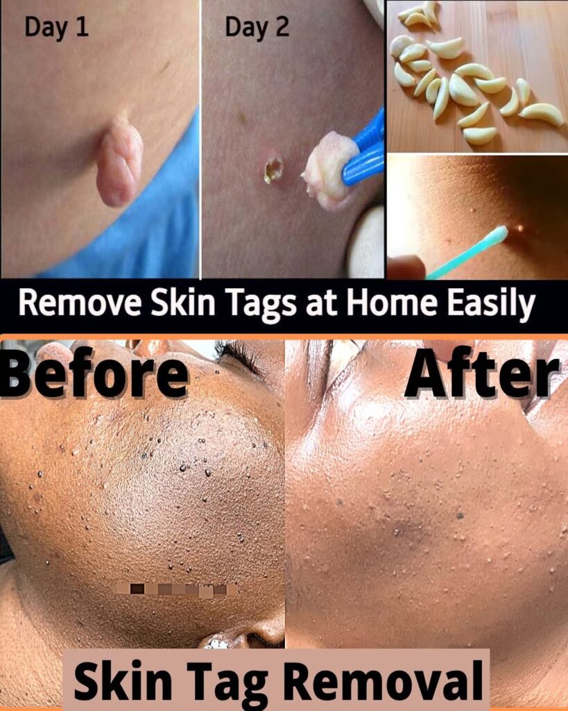 Remove Skin Tags Overnight with Vaseline