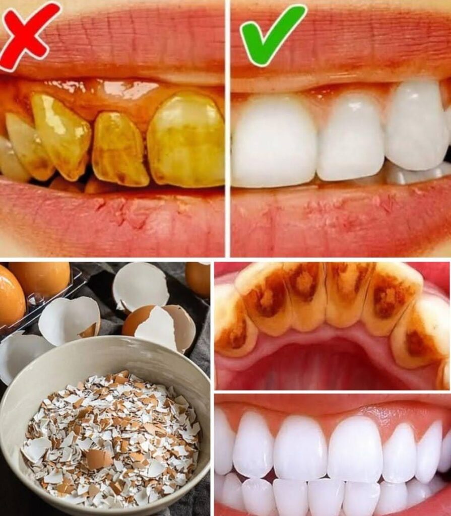 After 5 Minutes, Yellow Teeth Become Pearl White and Shiny