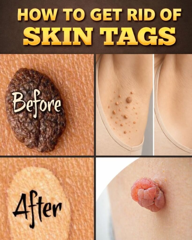 12 Popular Home Remedies People Use for Skin Tags at Home (Natural Ideas to Explore)