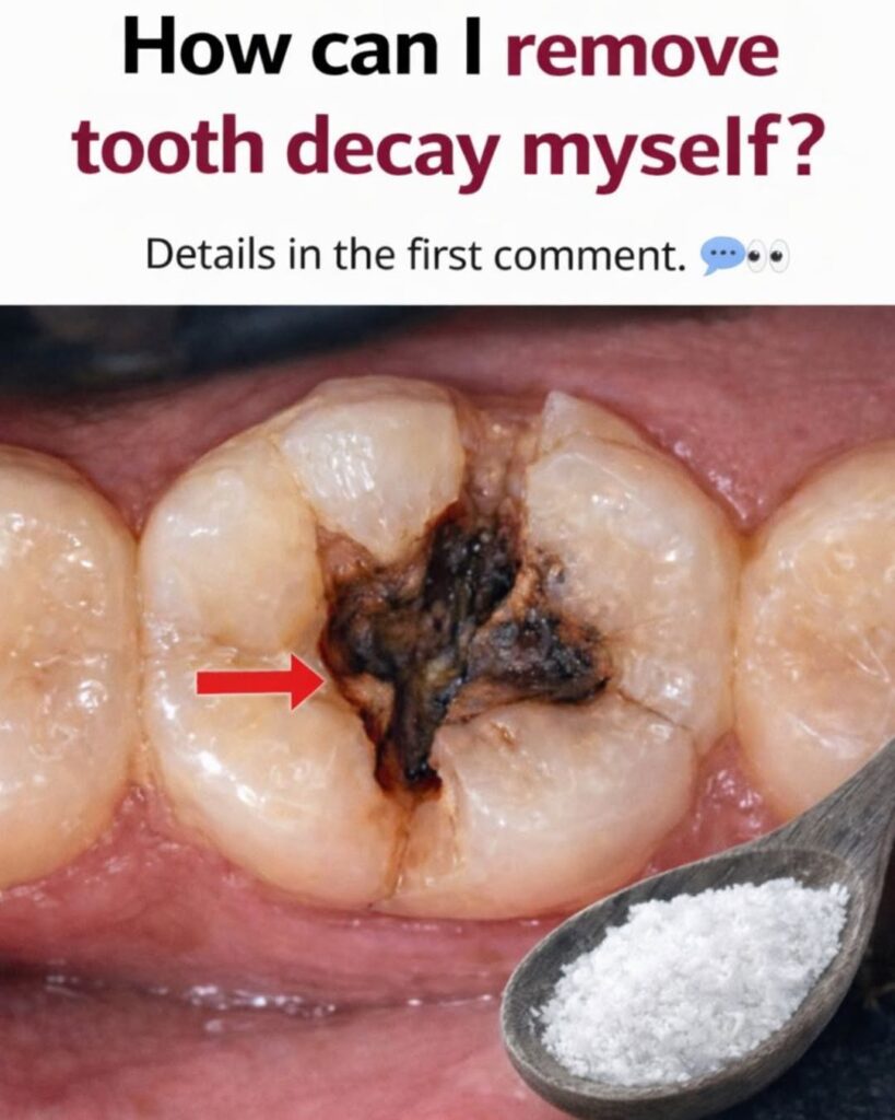 How Can I Remove Tooth Decay Myself? The Honest Truth (And What Actually Works)