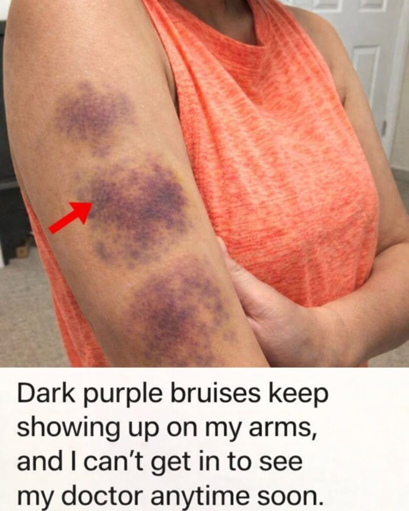 Dark Purple Bruises on Your Arms: Practical Steps to Take While Waiting for Your Doctor Appointment