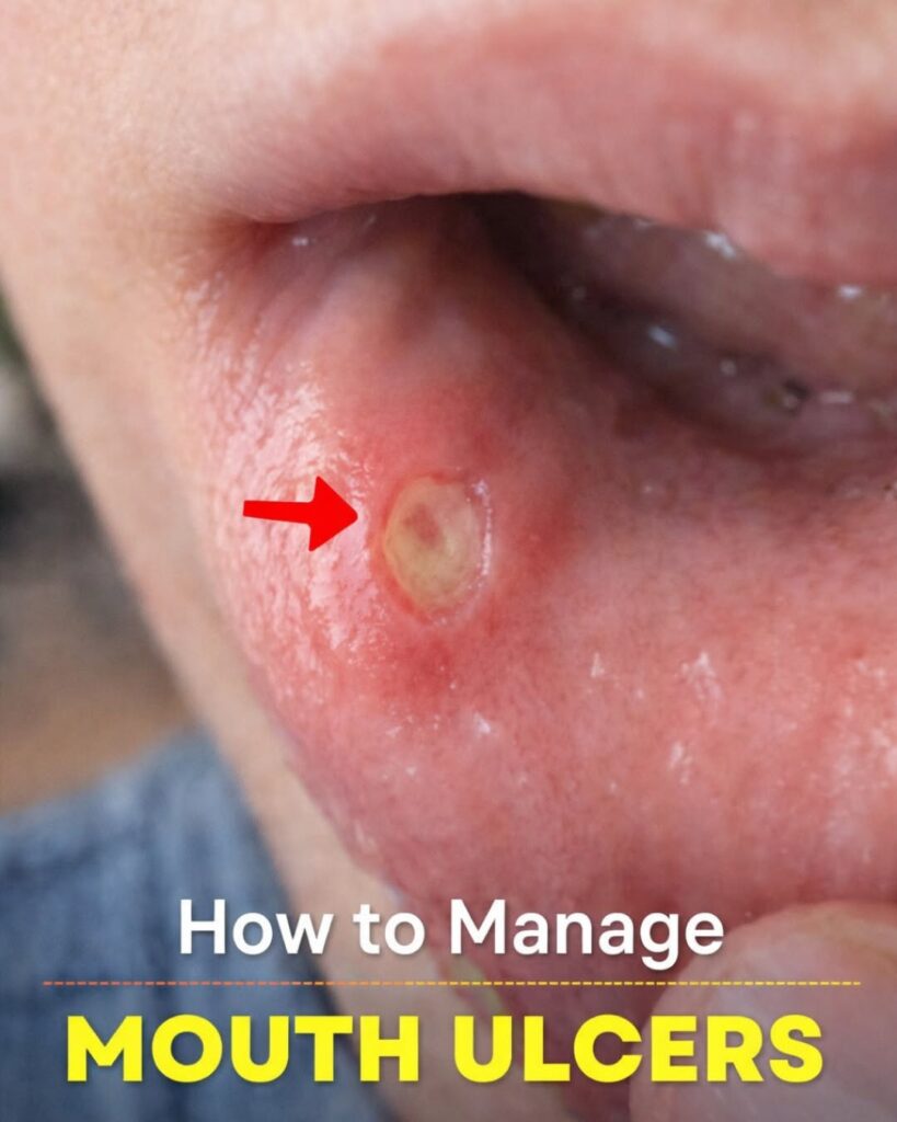 Understanding Aphthous Stomatitis: Your Guide to Canker Sores and How to Manage Them