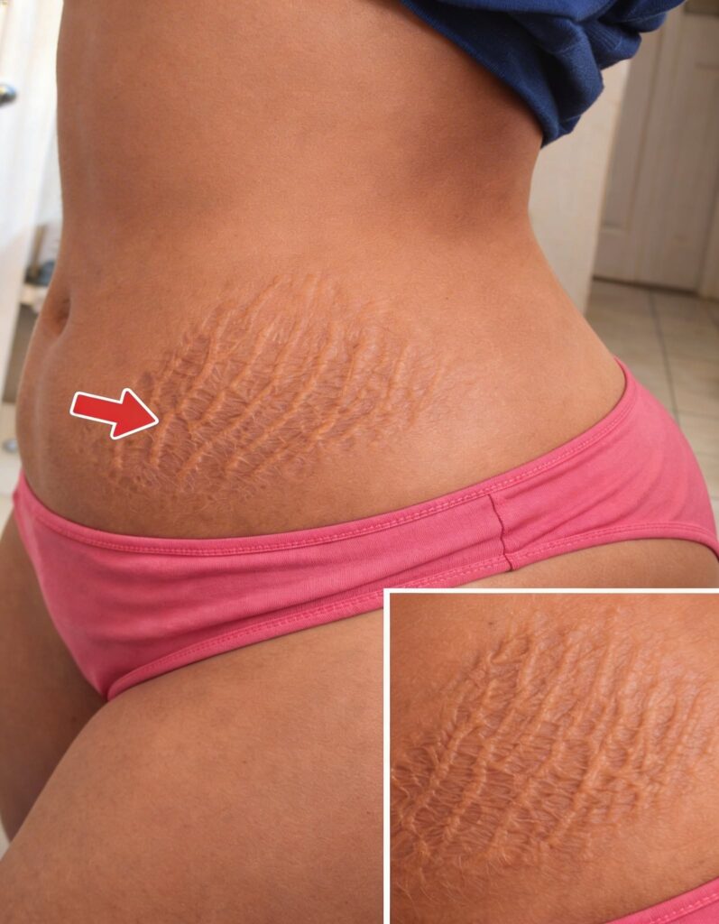 Understanding Stretch Marks: Common Causes and Practical Home Care Strategies for Skin Health