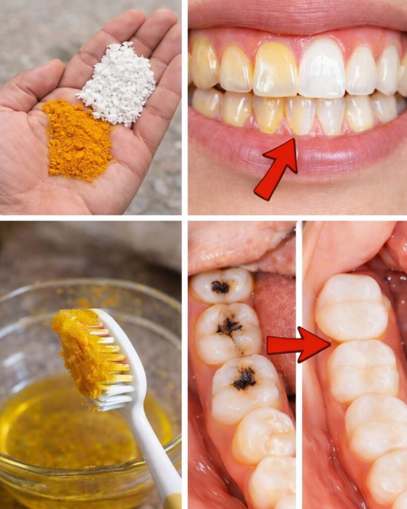 Turmeric for Teeth Whitening: Does This Natural Spice Actually Brighten Your Smile?
