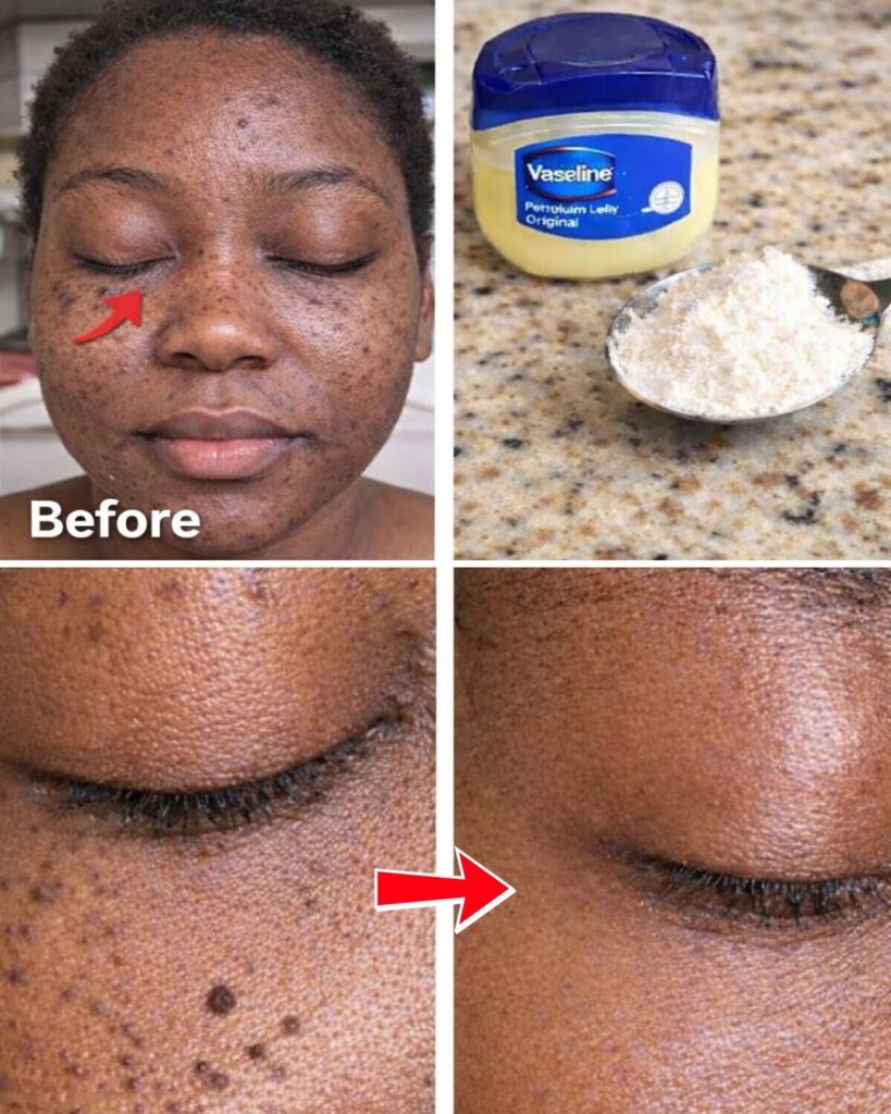 Those Stubborn Little White Bumps: Understanding Milia and Safe Ways to Improve Your Skin’s Appearance