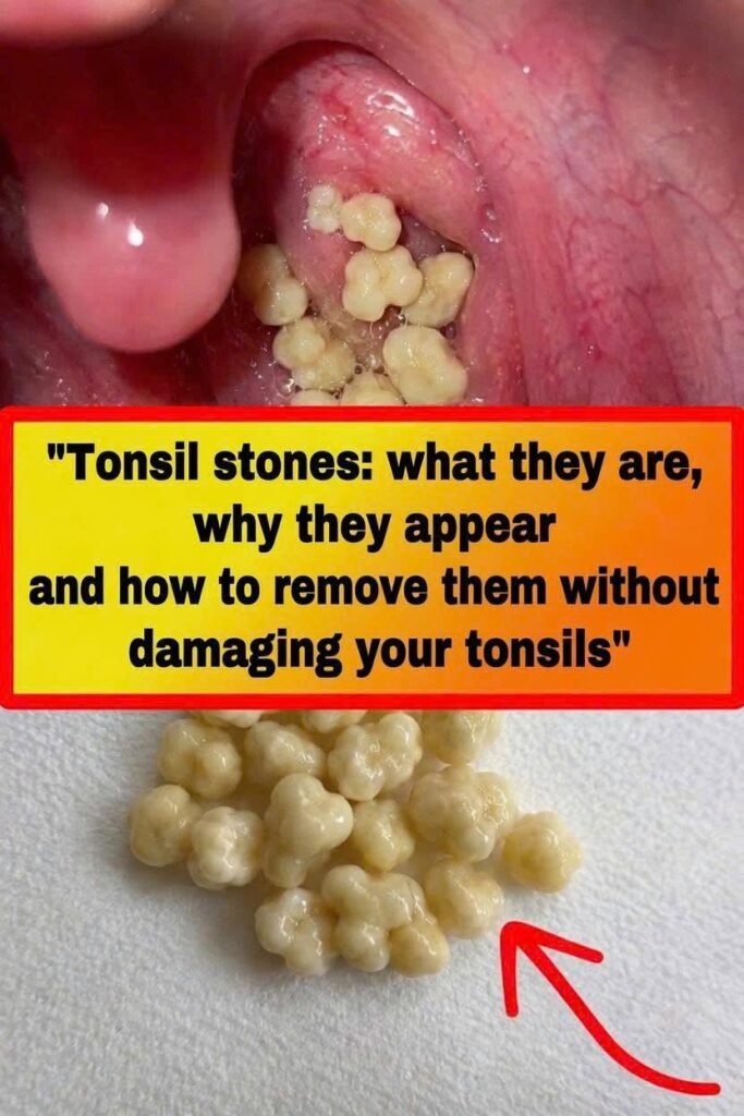 Tonsil Stones: What They Are, Why They Appear, and How to Remove Them Safely
