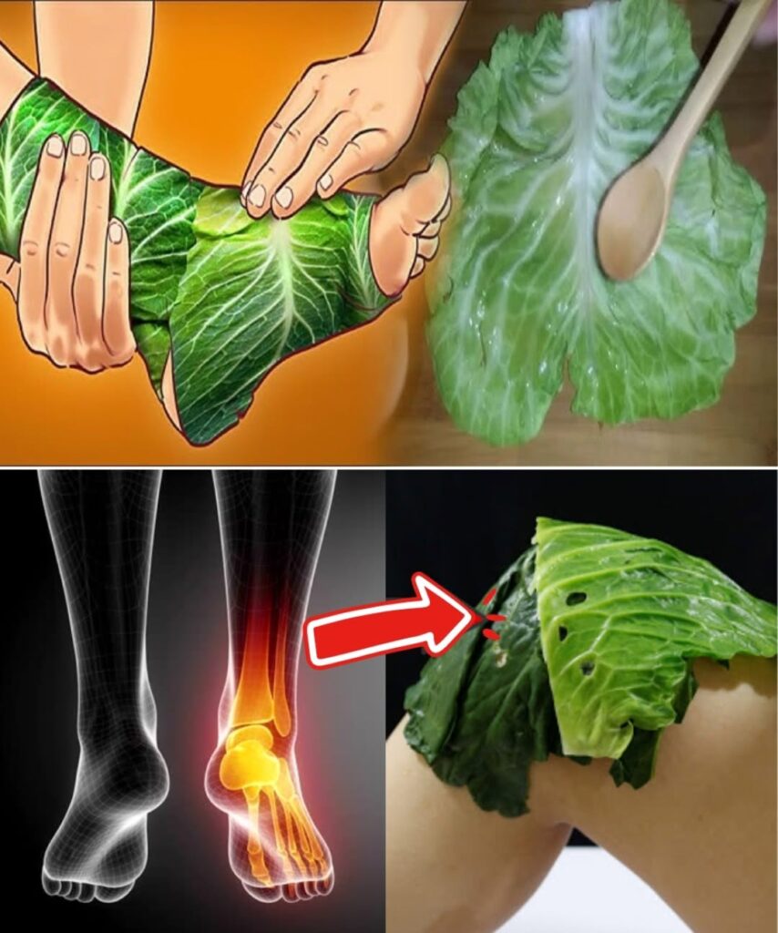 Natural Relief for Varicose Veins with Cabbage Leaves