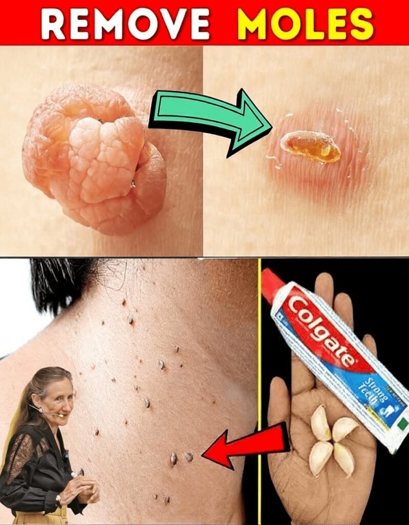 Natural Remedies for Warts and Skin Tags: Benefits, Limitations, and Safety