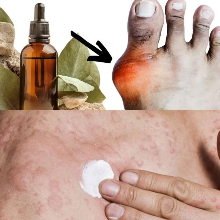 Amazing OIL Cures GOUT! Removes Pain, Swelling, Redness