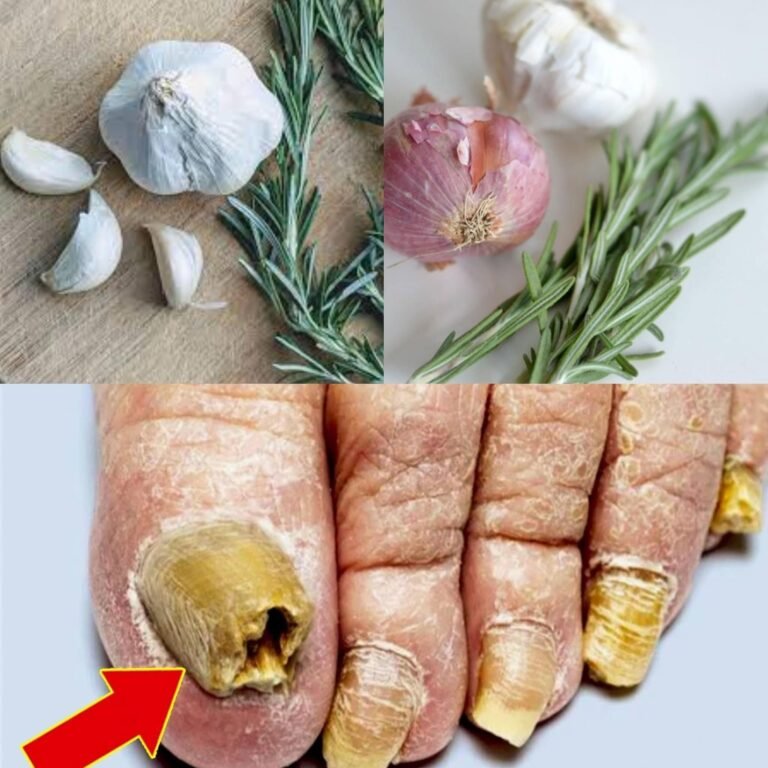 Garlic, Onion & Rosemary for Nail Fungus – Fact Check