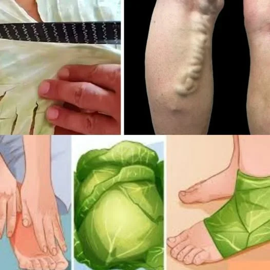 Natural Remedy for Varicose Veins: Cabbage Leaves