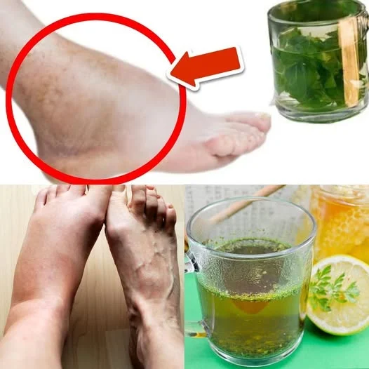 This Tea Removes Swelling in the Feet and Legs Forever – Try Parsley Tea!
