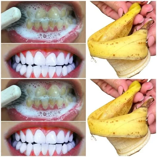 Fast Teeth Whitening in 1 Minute! Pearl White Smile Guaranteed with Banana Peels!