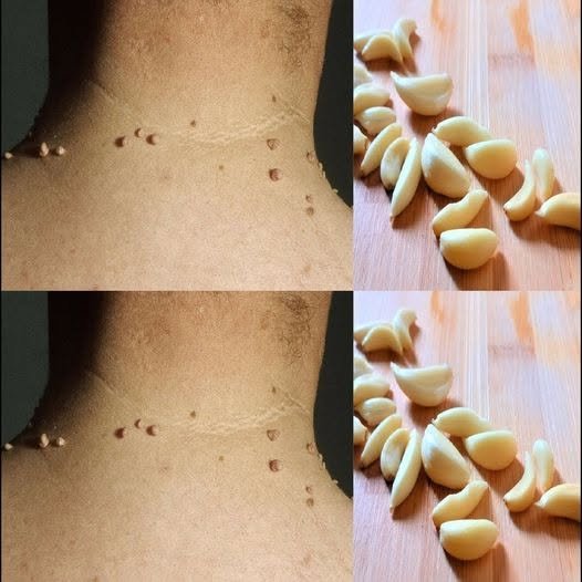 Skin Tags and Home Remedies: What You Should Know