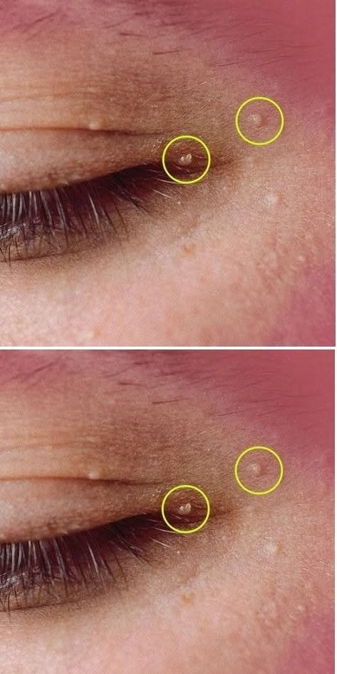 Small Bumps Near the Eyes: What You Should Know About Skin Health