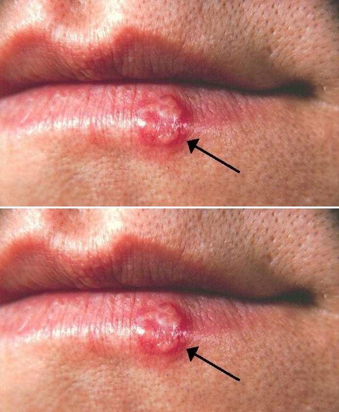 Lip Bumps and Sores: Causes, Care, and When to See a Doctor