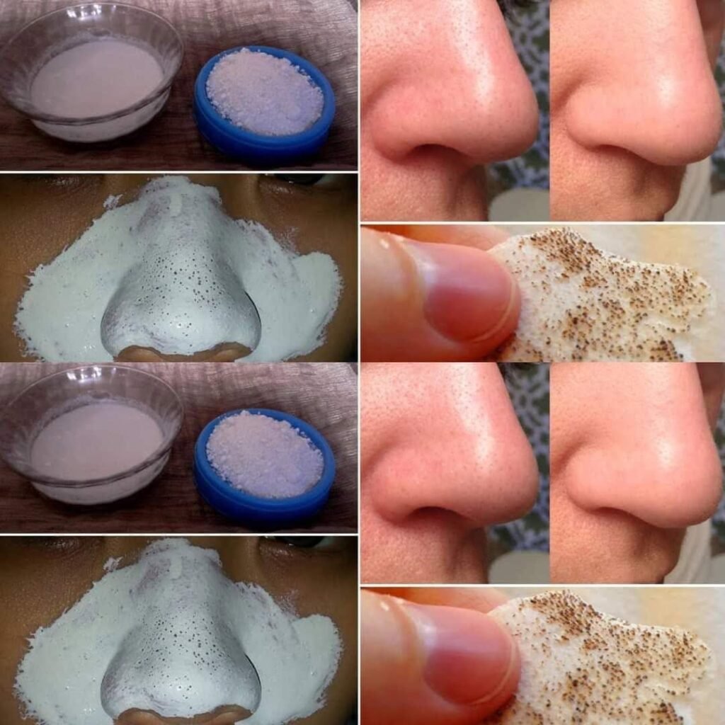 Blackheads Explained: Safe and Effective Ways to Remove Blackheads and Keep Your Skin Healthy