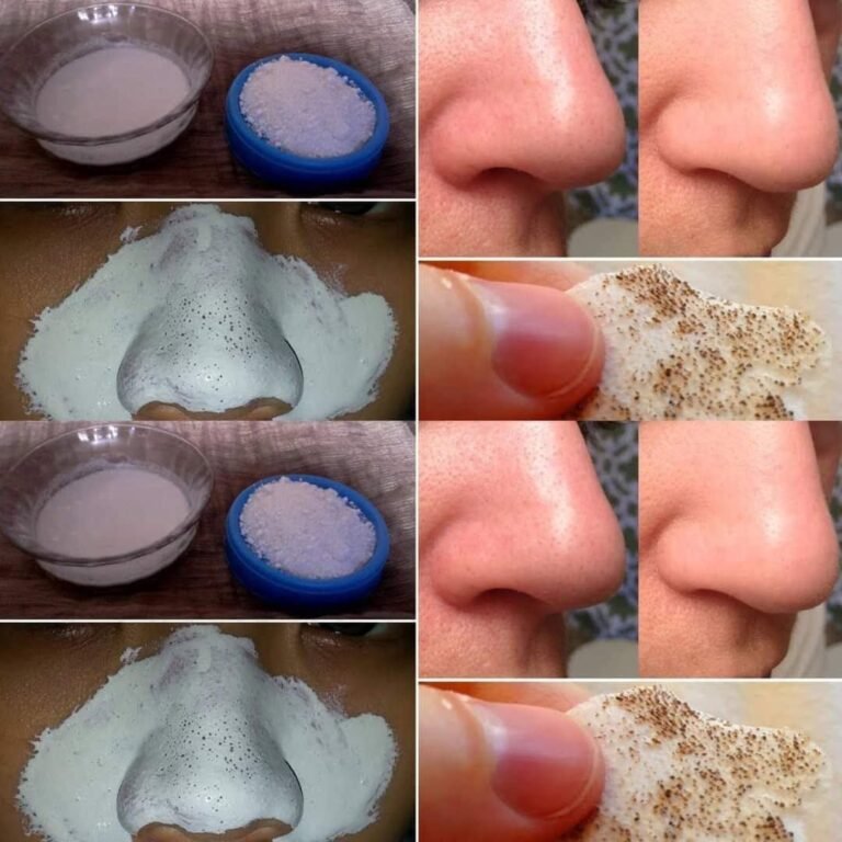 Blackheads Explained: Safe and Effective Ways to Remove Blackheads and Keep Your Skin Healthy