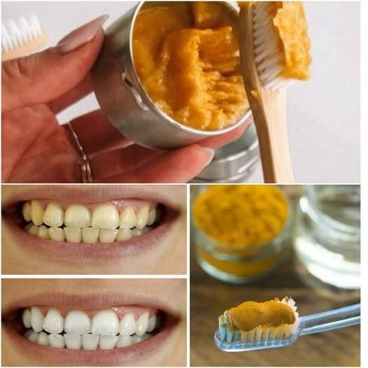Turmeric for Teeth: Can It Whiten Your Teeth? Facts, Benefits, Risks, and Safe Oral Care Tips