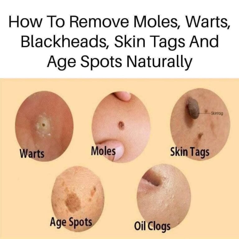 # Common Skin Marks: Moles, Warts, Skin Tags & Age Spots Explained