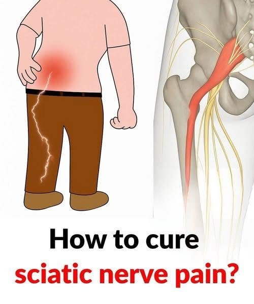 3 Effective Exercises to Help Relieve Sciatica Pain in the Leg