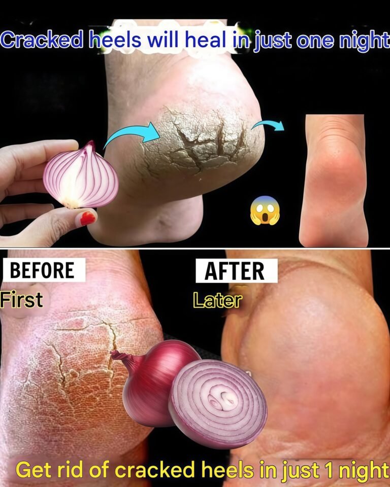 Heal Cracked Heels Overnight with Onion: The Surprising Natural Remedy