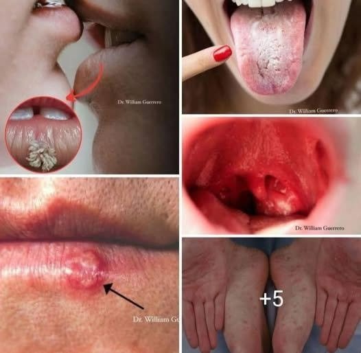 Mouth Cancer: Early Symptoms, Risk Factors, Diagnosis, Treatment, and Prevention