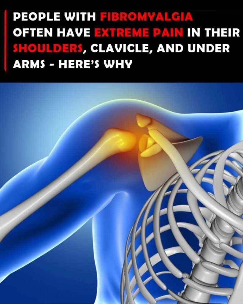 How Common Is Shoulder and Collarbone Pain in Fibromyalgia?