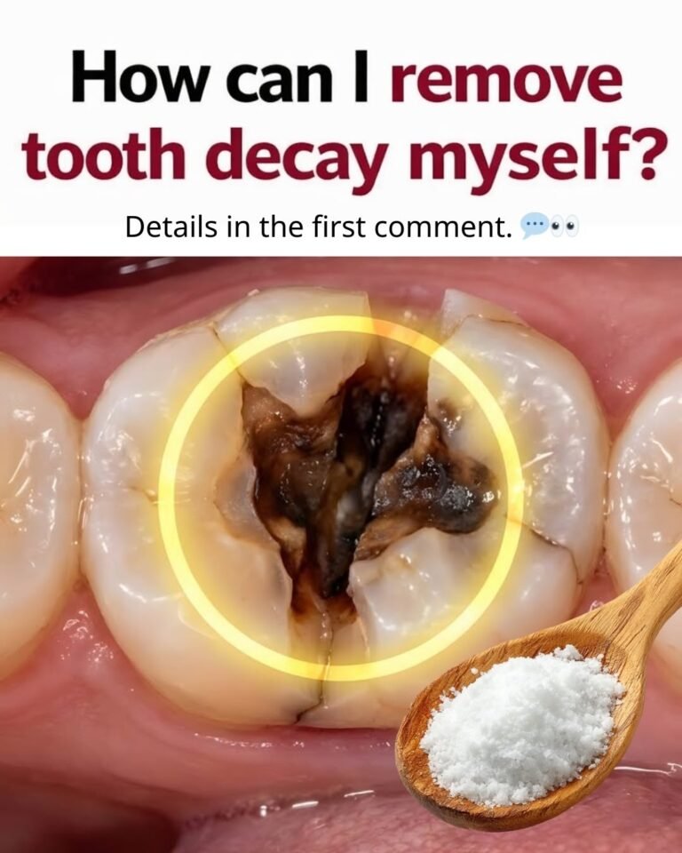 How Can I Remove Tooth Decay Myself? The Honest Truth (And What Actually Works)