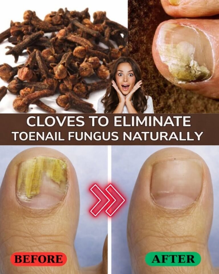 How to Eliminate Nail Fungus with Cloves