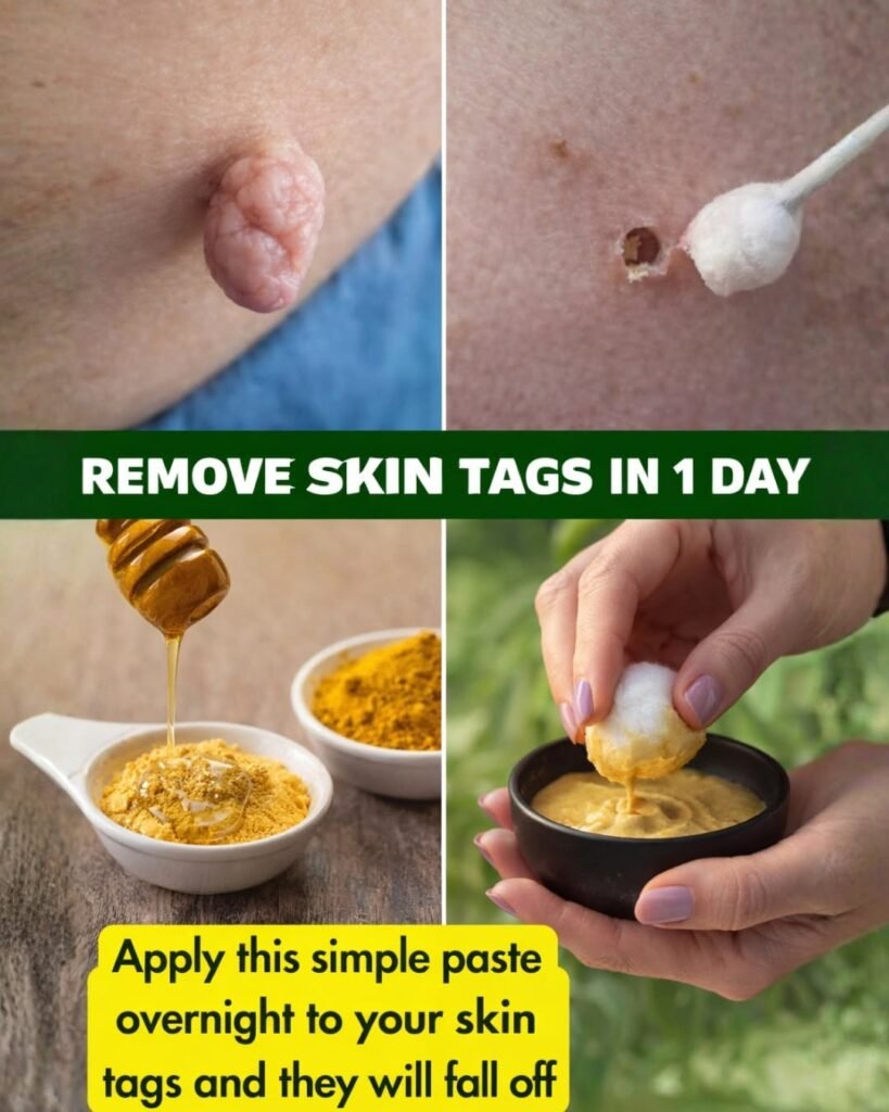 # Best Natural Home Remedies to Support Safe Skin Tag Removal