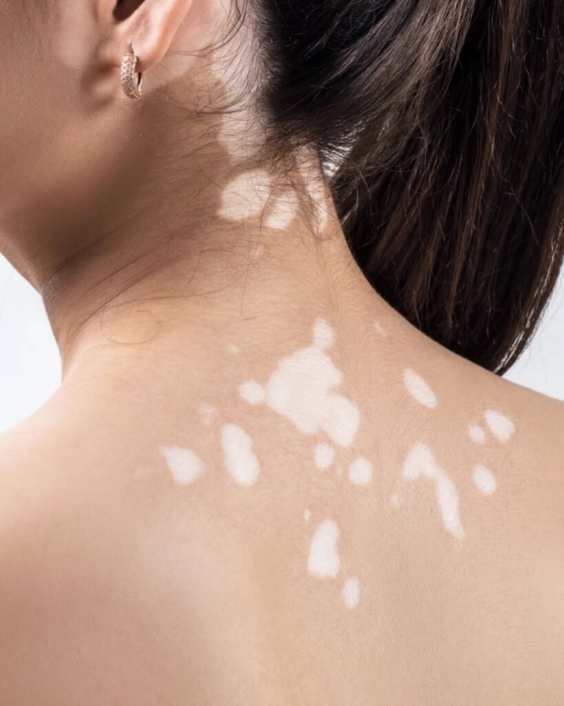 Many People Think It's Eczema — But It Could Be Tinea Versicolor: How to Tell the Difference