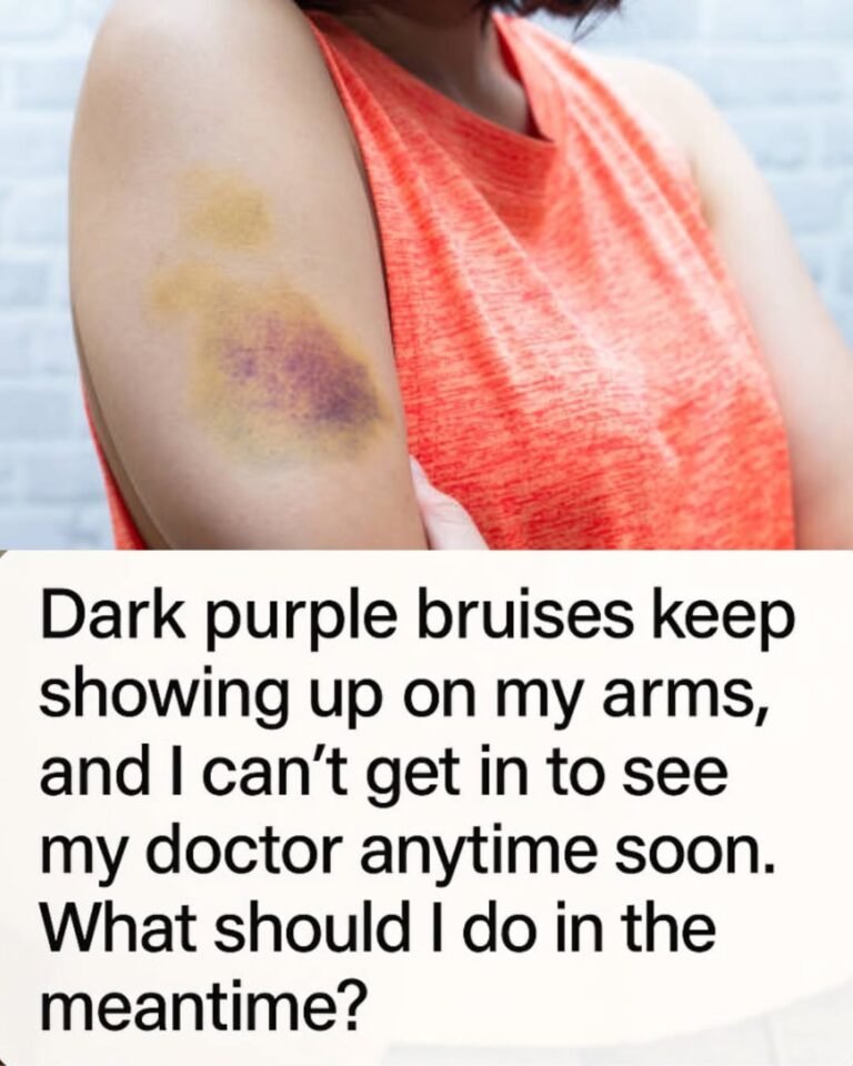 Dark Purple Bruises Appearing on Your Arms? What You Can Do While Waiting to See a Doctor