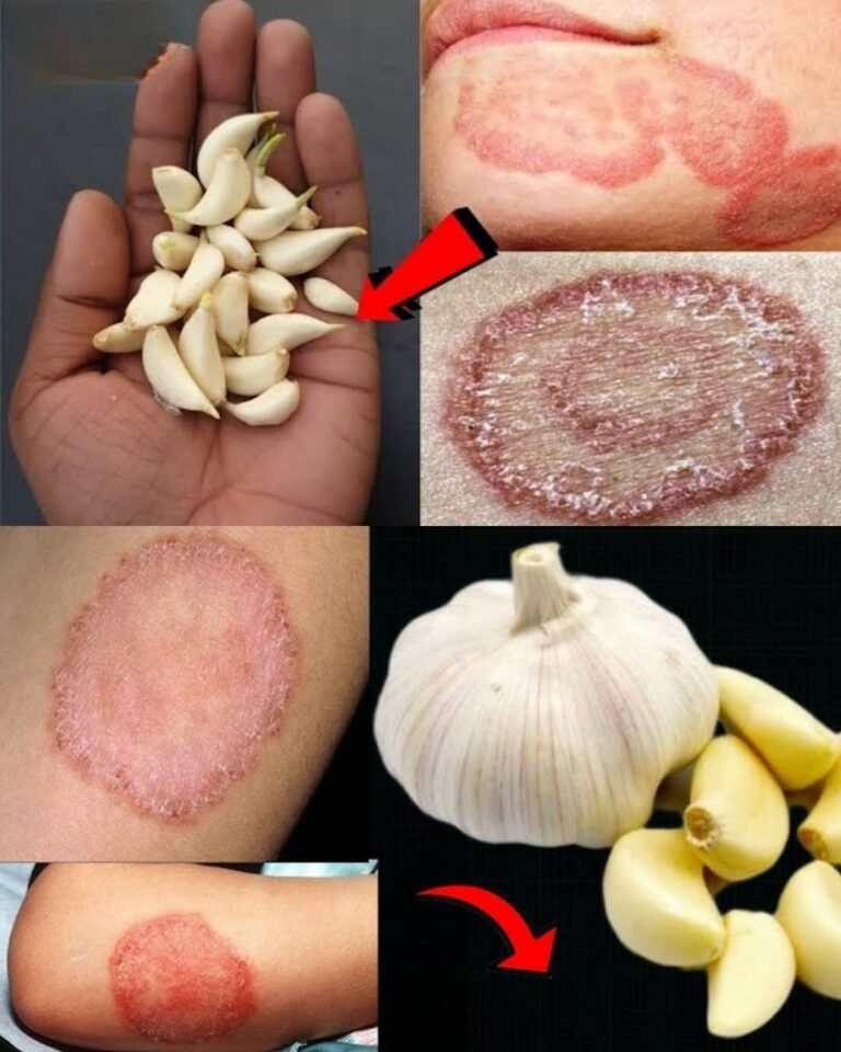 Garlic and Olive Oil for Fungal Skin Infections: Can This Natural Remedy Help?
