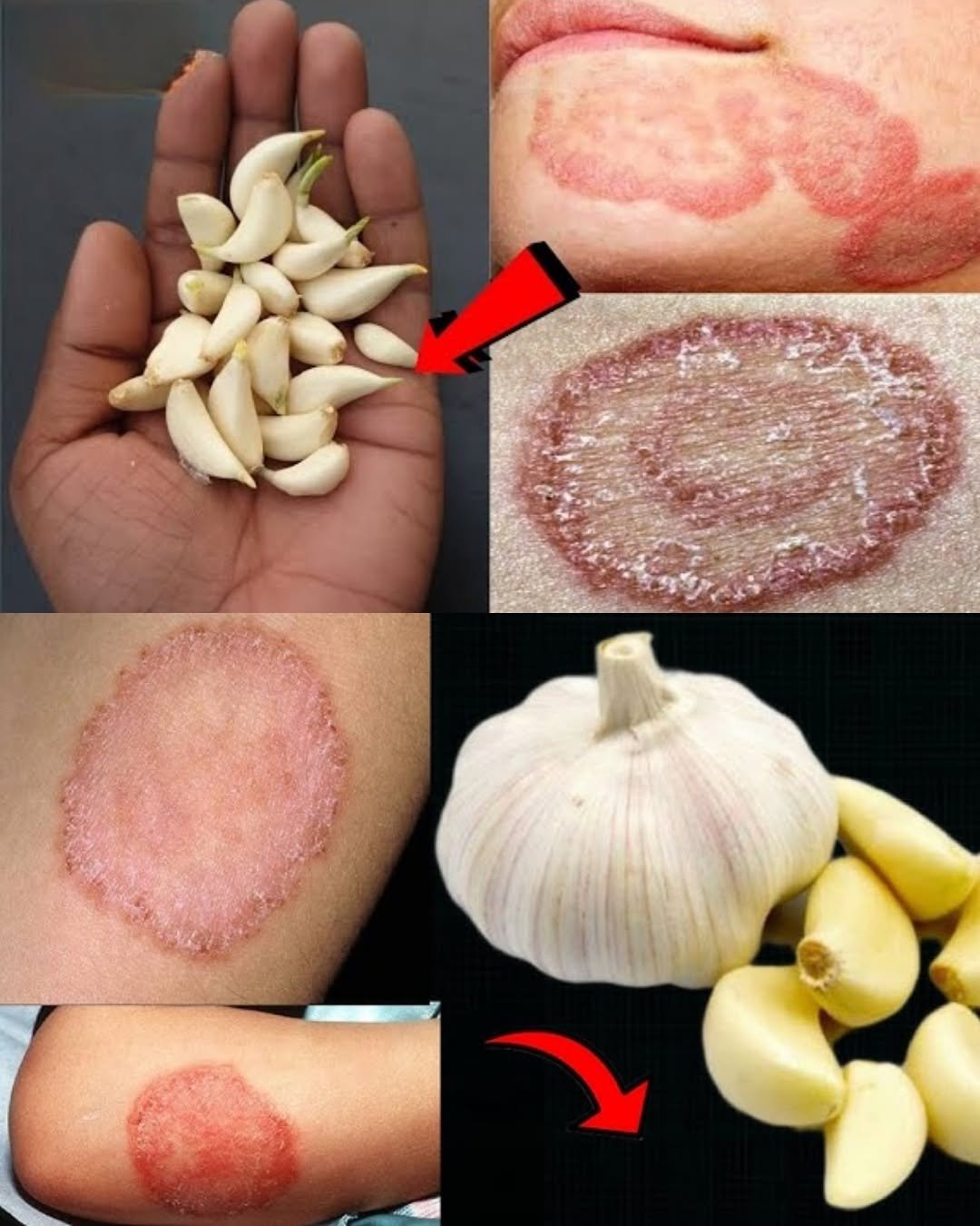 Garlic and Olive Oil for Fungal Skin Infections: Can This Natural Remedy Help?