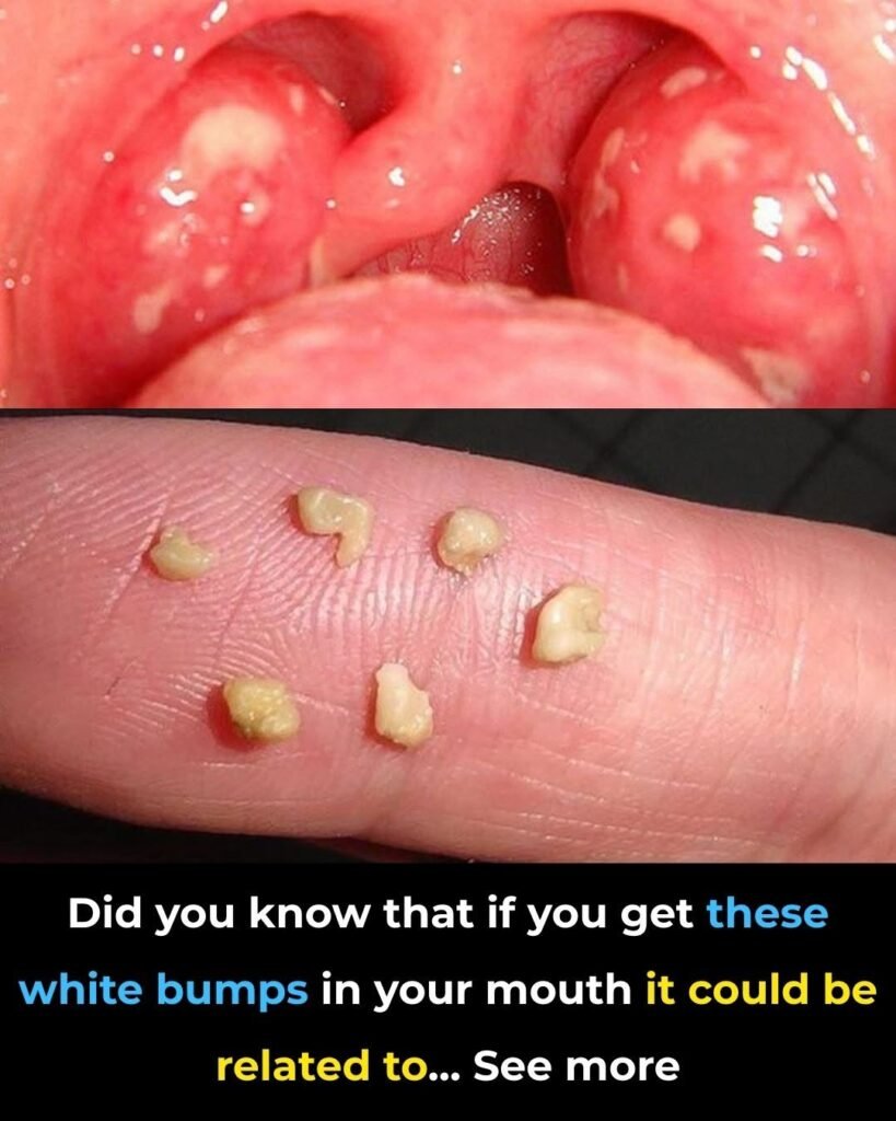 Here’s what you need to know about tonsil stones – the weird pimple-like growths in your throat