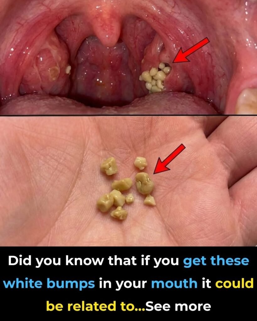 # White or Yellow Bumps on Your Tonsils? Here's What You Should Know About Tonsil Stones