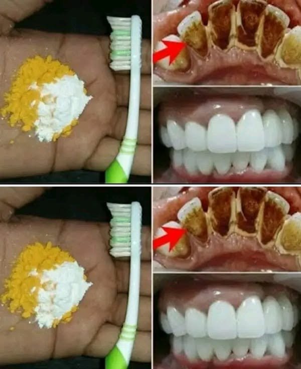 Home Teeth Whitening: Can Turmeric and Baking Soda Really Make Teeth Whiter in 2 Minutes?