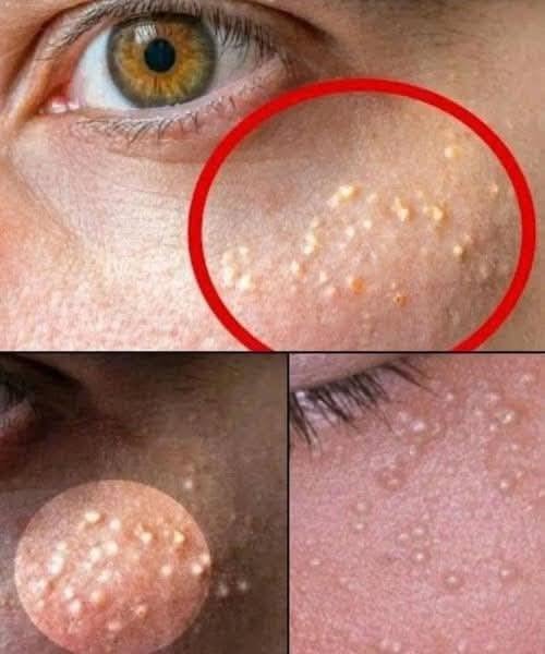 Tiny White Bumps on Your Face? Understanding Milia and Safe Ways to Treat Them Naturally