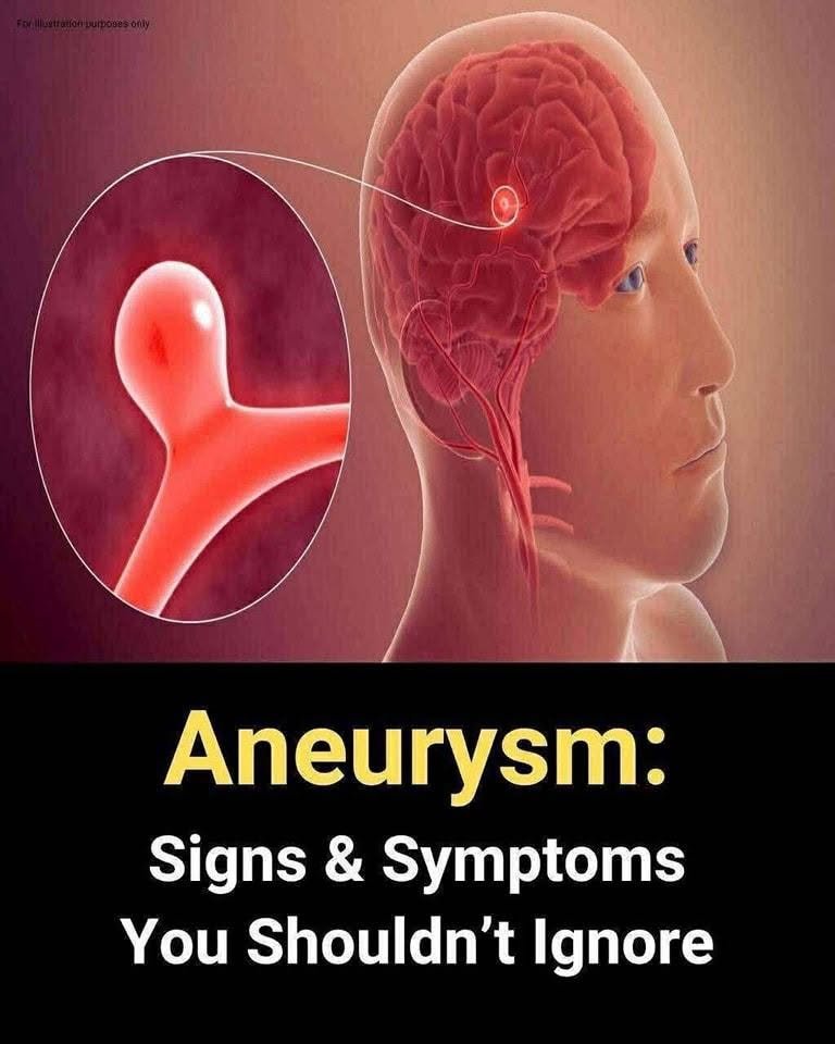 Aneurysm Warning Signs: Symptoms You Should Never Ignore and How to Reduce Your Risk