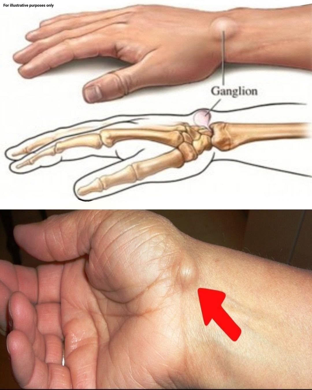 Noticed a Lump on Your Hand? Common Causes, Warning Signs, and When to See a Doctor